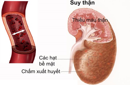 Điều trị suy thận bằng tế bào gốc được không?