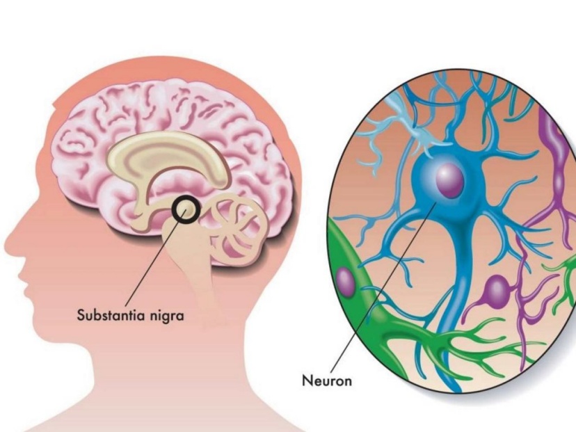 Điều trị bệnh Alzheimer và Parkinson bằng tế bào gốc từ răng sữa