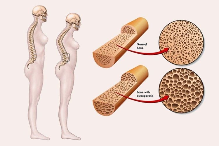 Bệnh loãng xương có nguy hiểm không?