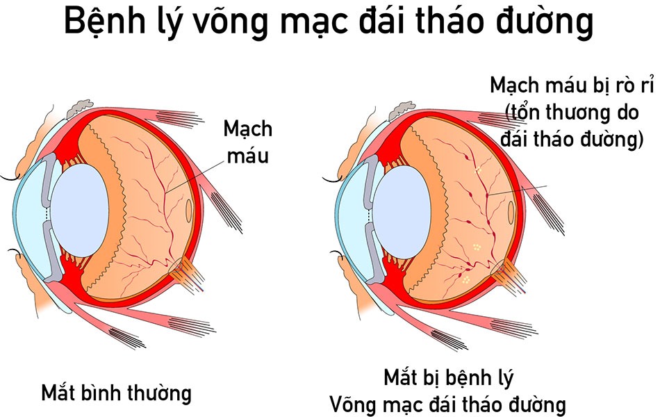 Võng mạc đái tháo đường là bệnh gì?