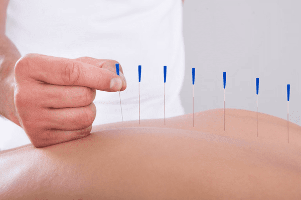 châm cứu chữa thoát vị đĩa đệm