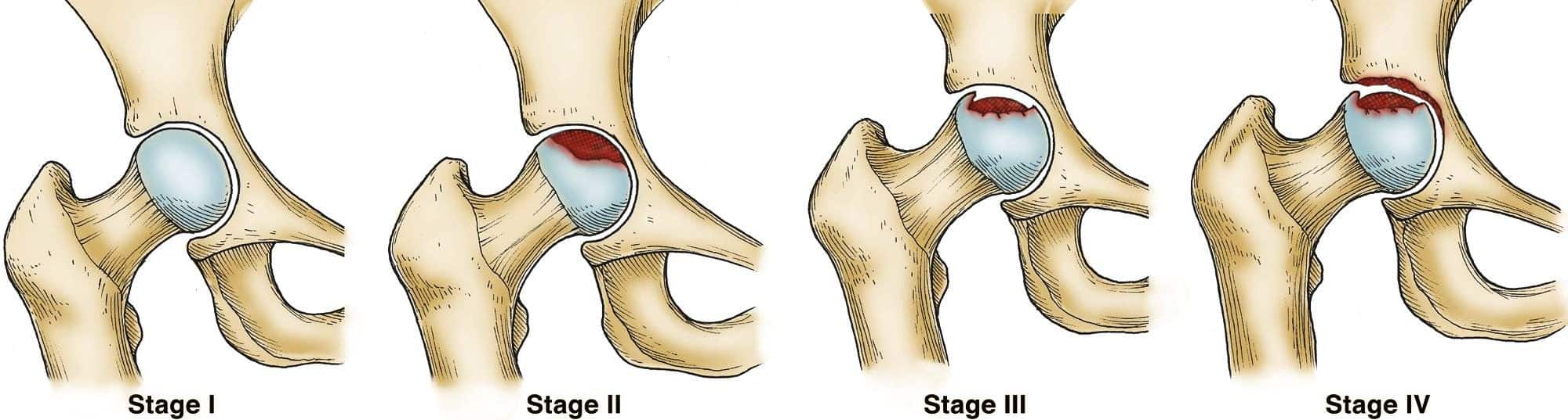 Các phương pháp điều trị hoại tử khớp háng