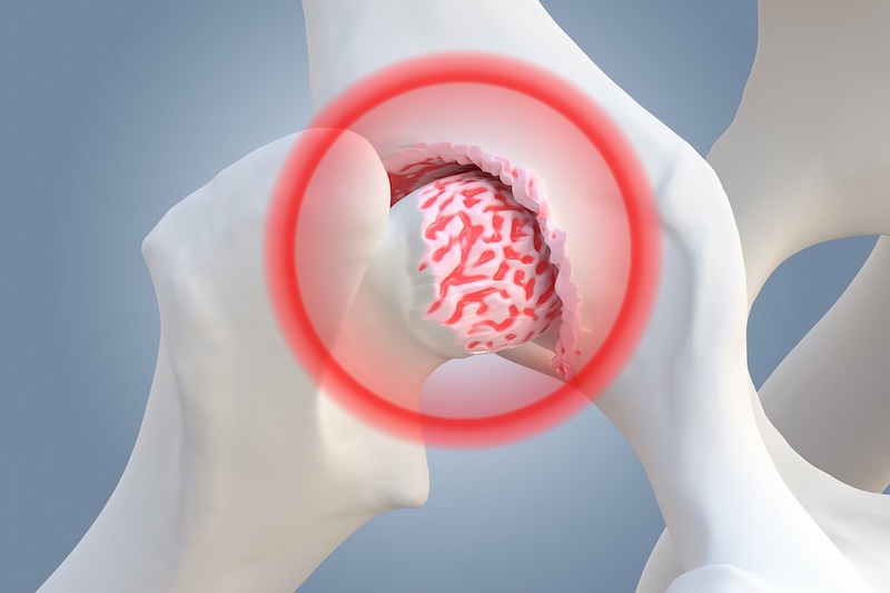 Hoại tử xương gây ra những hậu quả nghiêm trọng