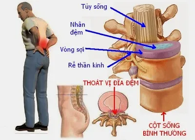 Nguyên nhân gây ra thoát vị đĩa đệm