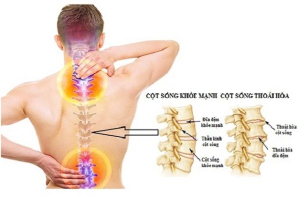 Thoái hóa đốt sống cổ chèn dây thần kinh nào?