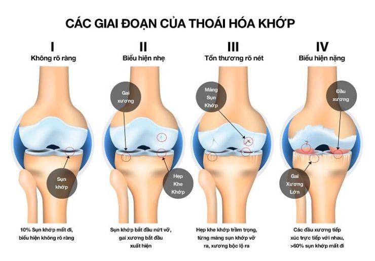 Các giai đoạn phát triển bệnh