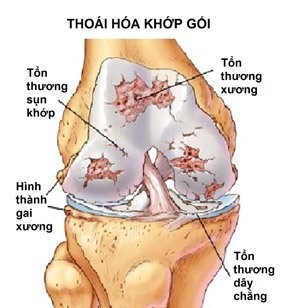 Nguyên nhân gây ra thoái hóa khớp gối