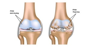 Thoái hóa khớp gối