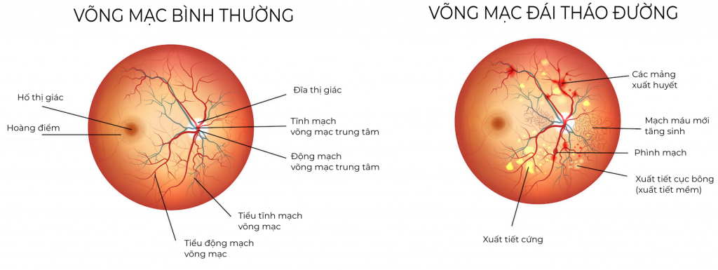 Dấu hiệu của bệnh võng mạc đái tháo đường