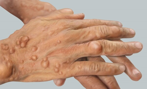 Schwannomatosis