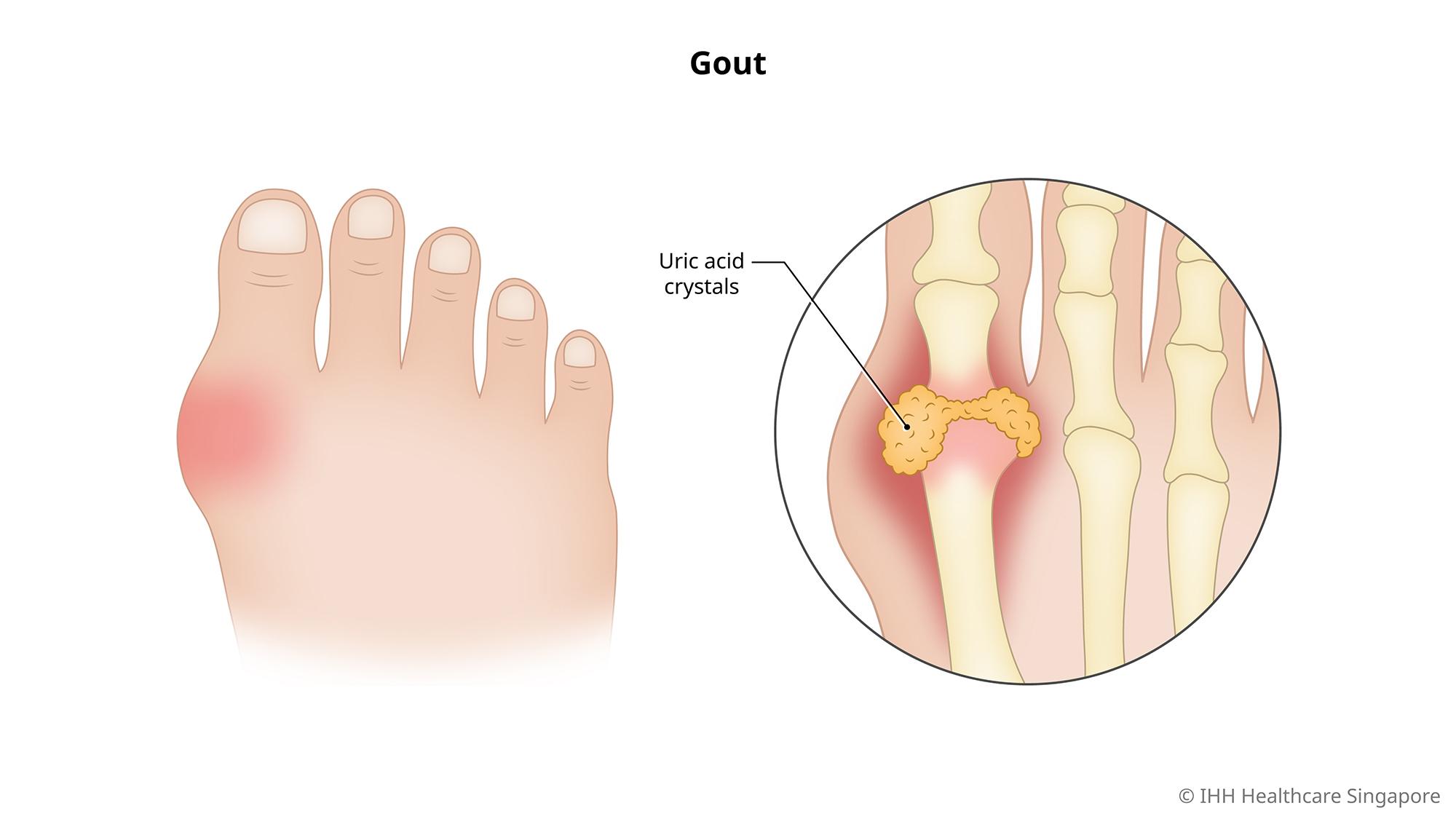 Bệnh gout có nguy hiểm không?