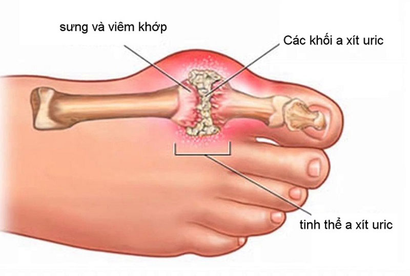 Bệnh gout có chữa khỏi được không?