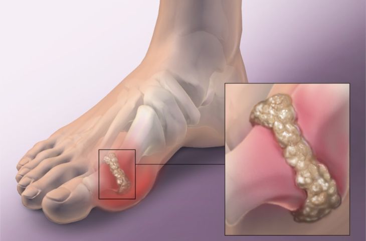 Cách điều trị bệnh gout