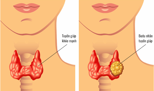 Bệnh suy giáp là bệnh gì?