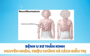bệnh u xơ thần kinh