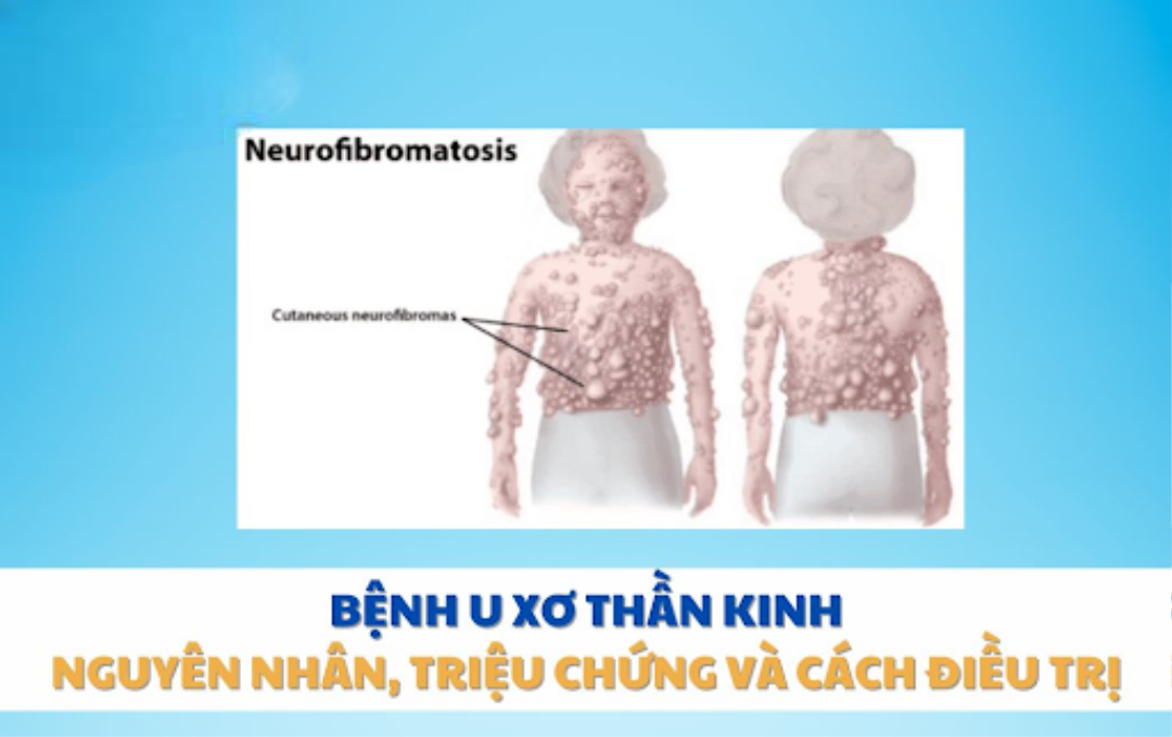 bệnh u xơ thần kinh