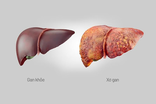 Bệnh xơ gan là gì?