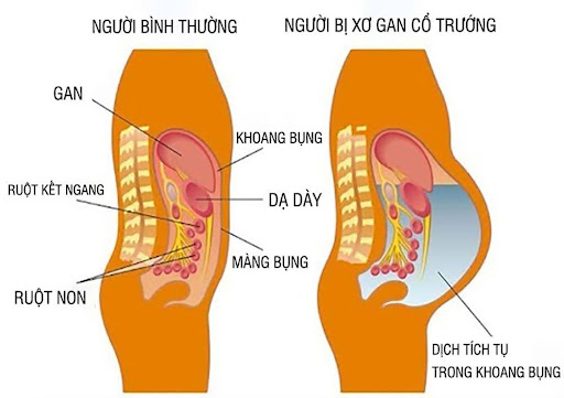 Biến chứng người bị xơ gan cổ trướng