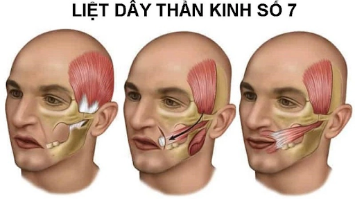 Liệt dây thần kinh số 7 là bệnh gì