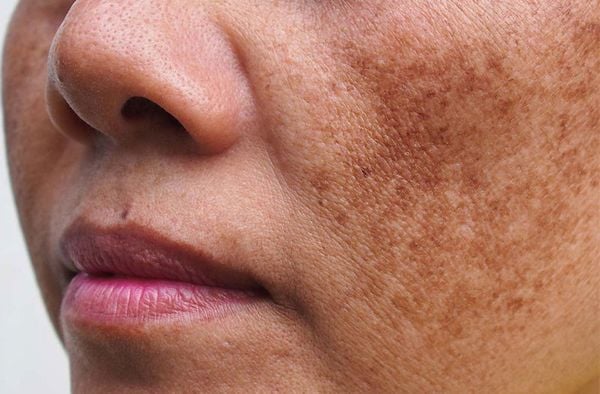 Biểu hiện rối loạn sắc tố da