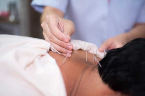 Châm cứu trị bệnh gai cột sống