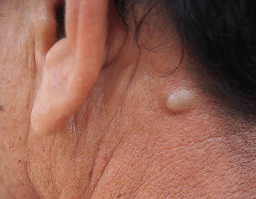 Chi phí điều trị u xơ thần kinh tại Việt Nam