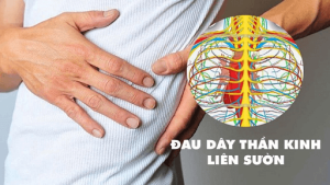 Đau dây thần kinh liên sườn có sao không? Nguyên nhân & cách điều trị