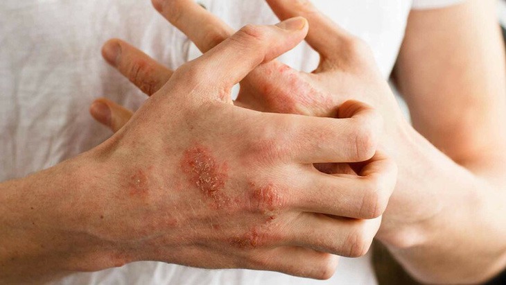 Các dấu hiệu của bệnh tự miễn