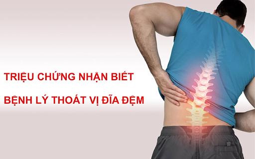 Dấu hiệu thoát vị đĩa đệm