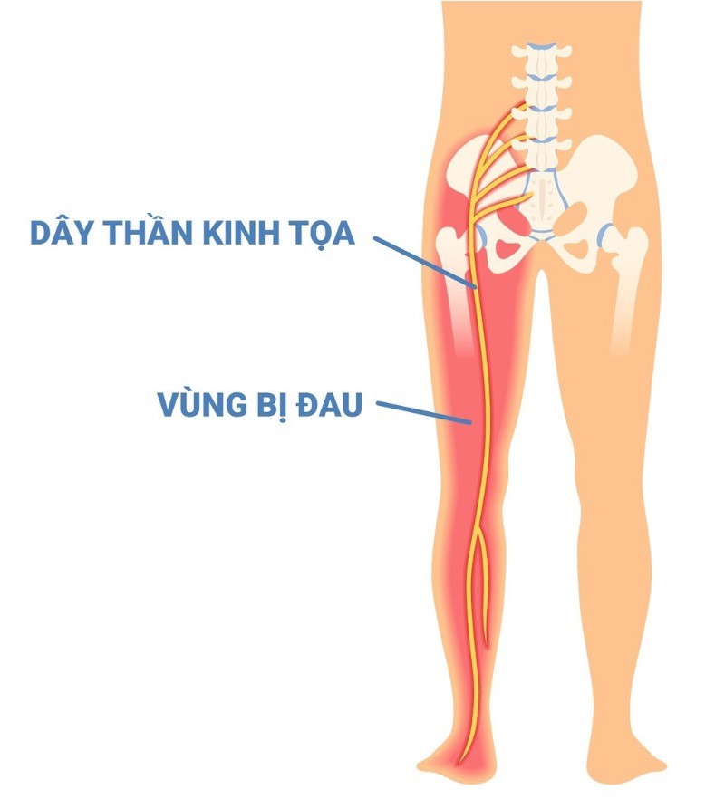 Đau thần kinh toạ là gì?