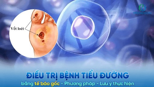 Điều trị tiểu đường bằng tế bào gốc