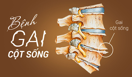Đối tượng mắc bệnh gai cột sống