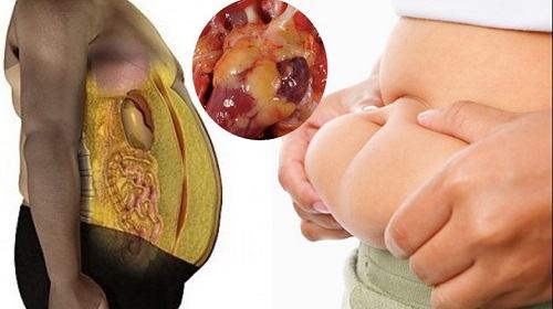 Gan nhiễm mỡ chữa được không?