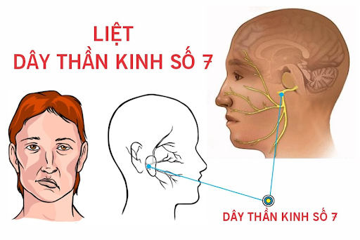 Liệt dây thần kinh số 7 ngoại biên có nguy hiểm không? Cách điều trị hiệu quả