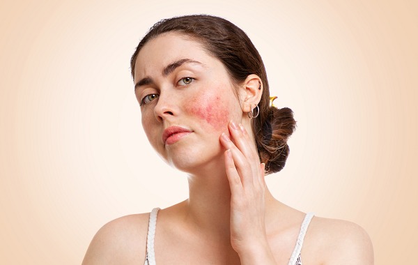 Lupus ban đỏ hệ thống