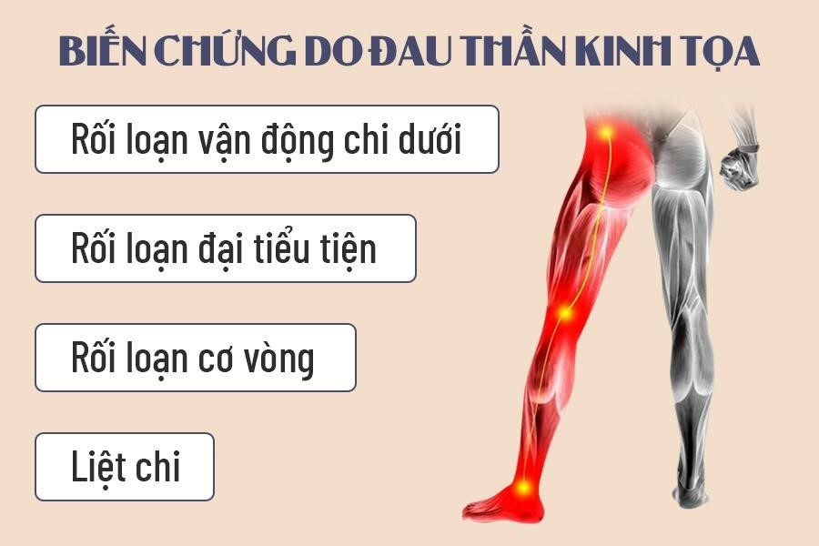 Đau thần kinh toạ gây nhiều hệ quả nghiêm trọng