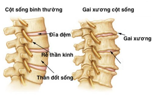Nguyên nhân của bệnh gai cột sống