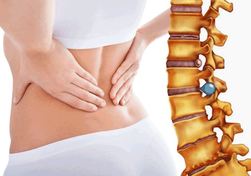Nguyên nhân thoát vị đĩa đệm