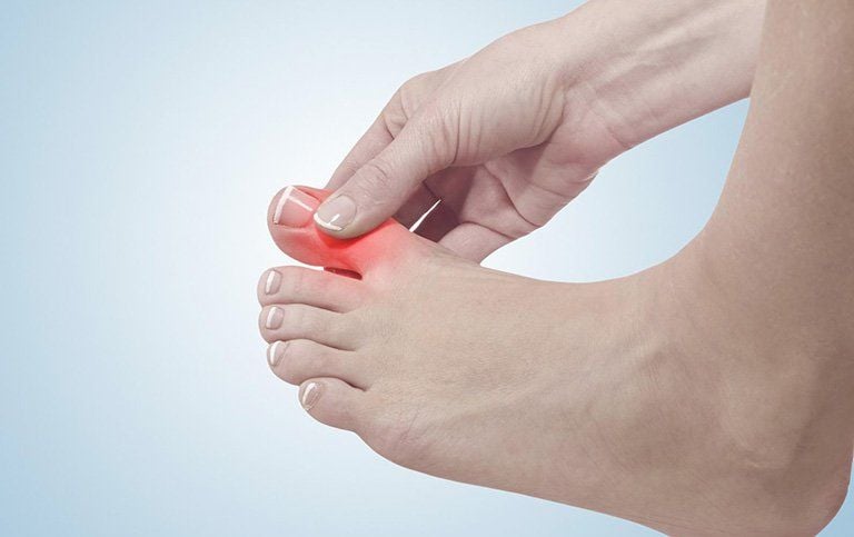 Cách phòng ngừa bệnh Gout