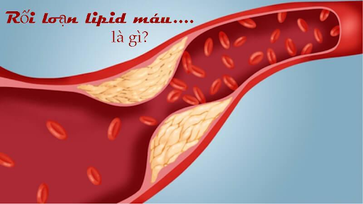 Rối loạn lipid máu là gì?