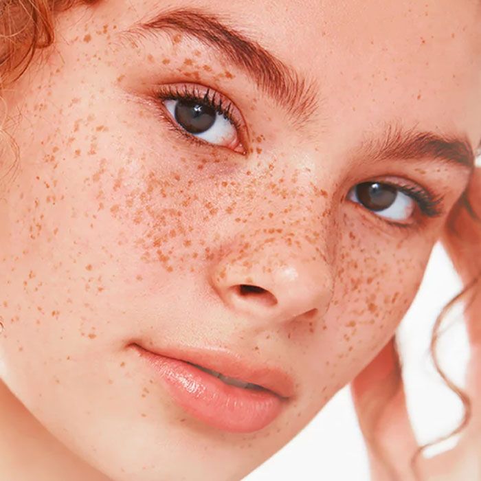 Rối loạn Melanin ảnh hướng tới cơ thể người