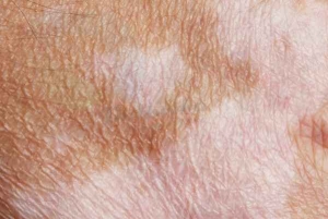 Rối loạn sắc tố da là gì?