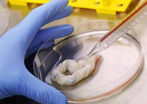 Tế bào gốc dây rốn cải thiện chức năng gan và tăng tỷ lệ sống