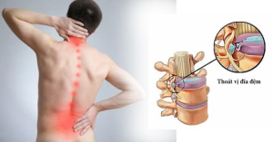 Nguyên nhân thoát vị đĩa đệm & Cách chữa thoát vị đĩa đệm hiệu quả