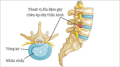 Thoát vị đĩa đệm có nguy hiểm không