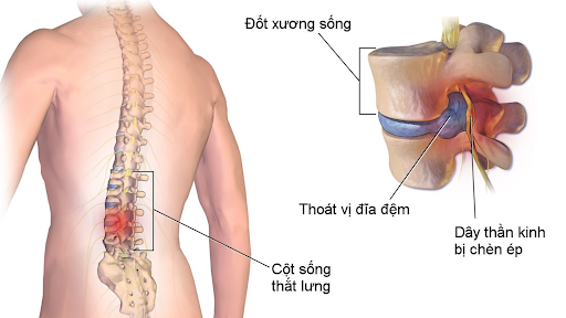 Thoát vị đĩa đệm là bệnh gì?