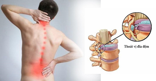 Nguyên nhân thoát vị đĩa đệm & Cách chữa thoát vị đĩa đệm hiệu quả