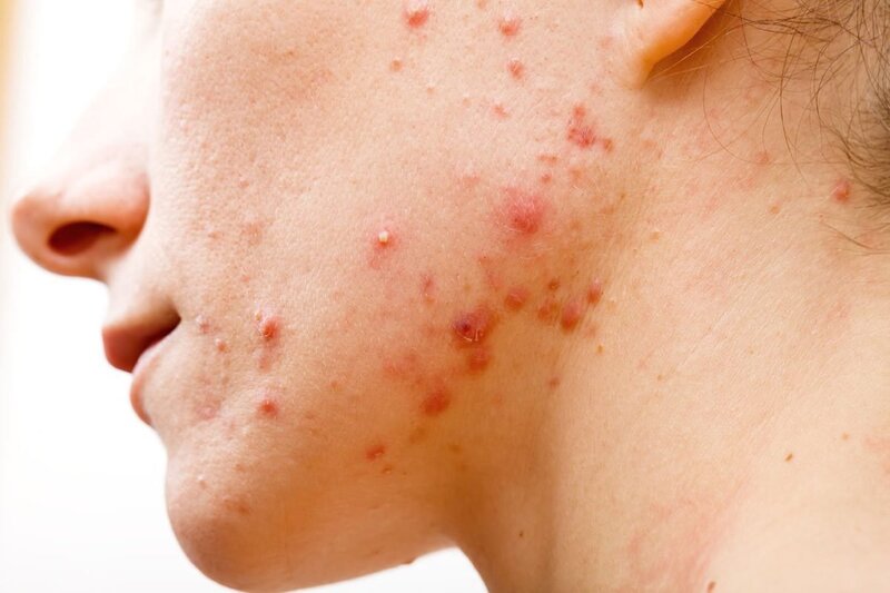 Các tổn thương da gây tăng sắc tố cục bộ