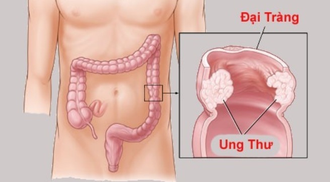 NMN có thể ngăn chặn ung thư đại trực tràng không