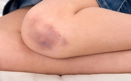 MSCs hứa hẹn cho bệnh khớp do Hemophilia